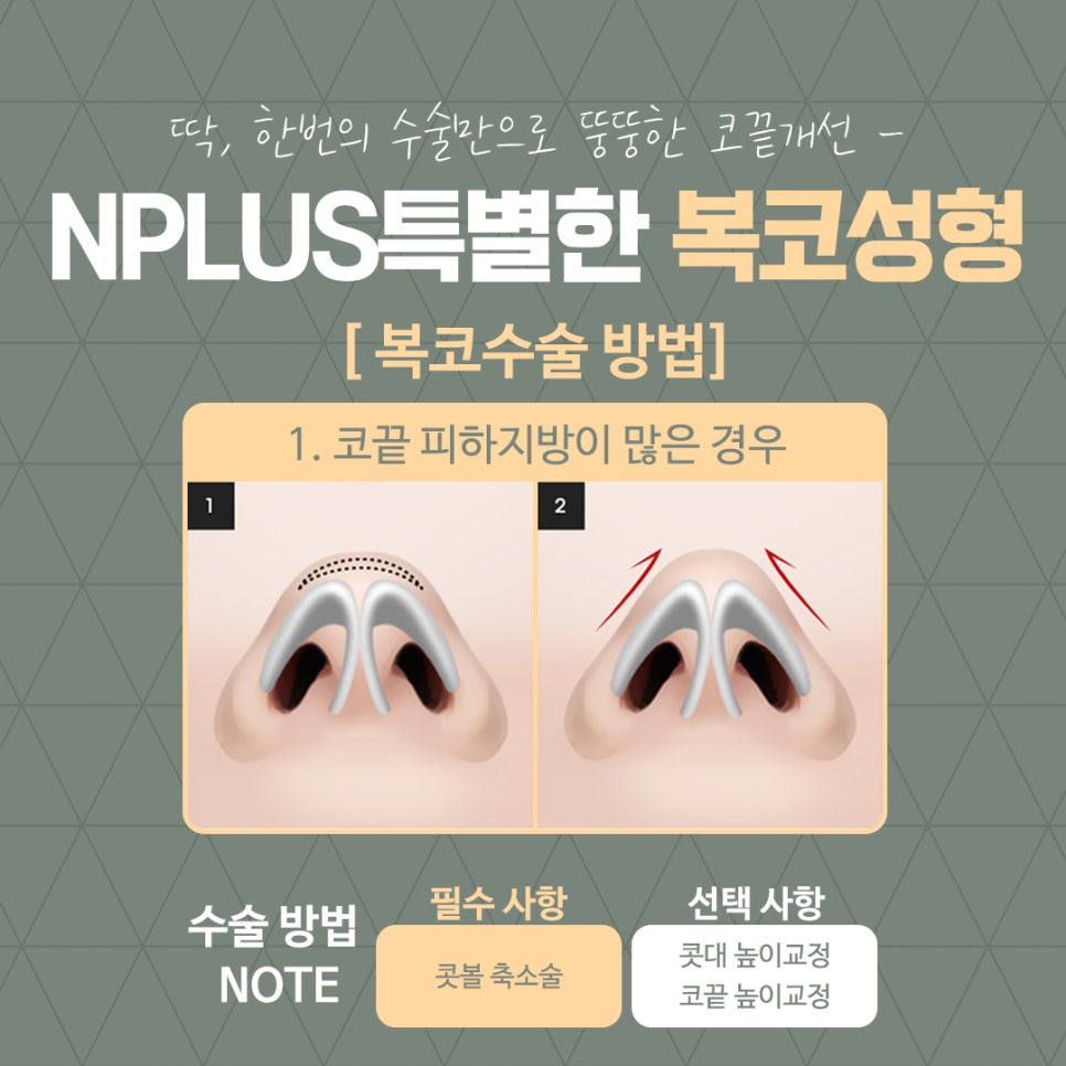 복코성형으로 세련된 이미지 변신 관련 이미지 9