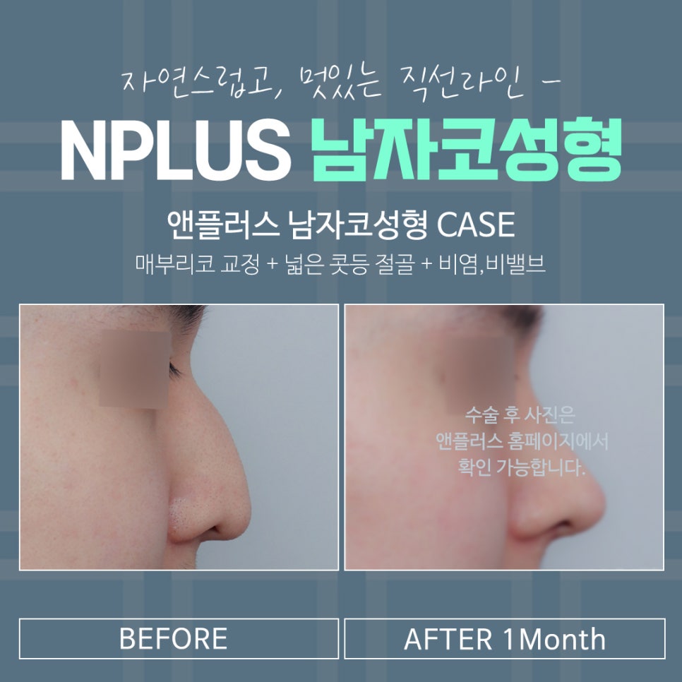 남자코수술전후 변화를 확인해 보고 관련 이미지 7