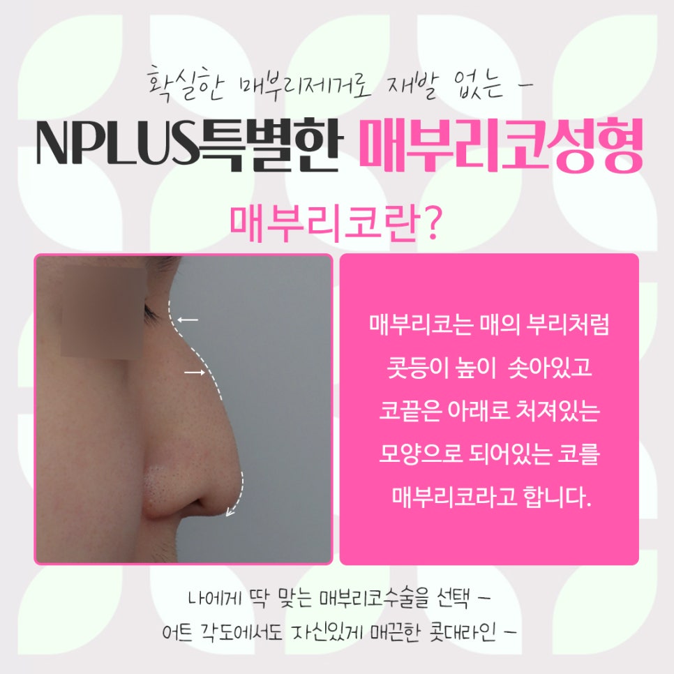 A Refined Look Through Female Hump Nose Surgery image 4