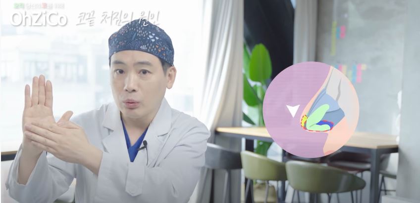 코성형 후 코끝처짐 원인과 해결 방법 관련 이미지 12