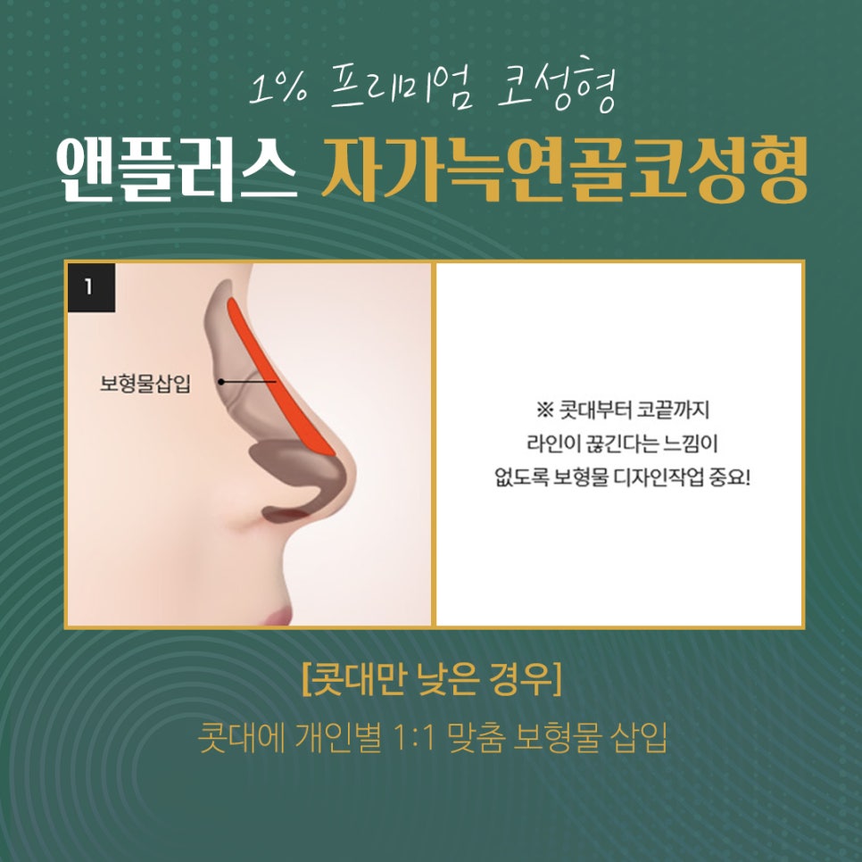 자가늑연골코수술로 처음부터 확실하게 관련 이미지 4