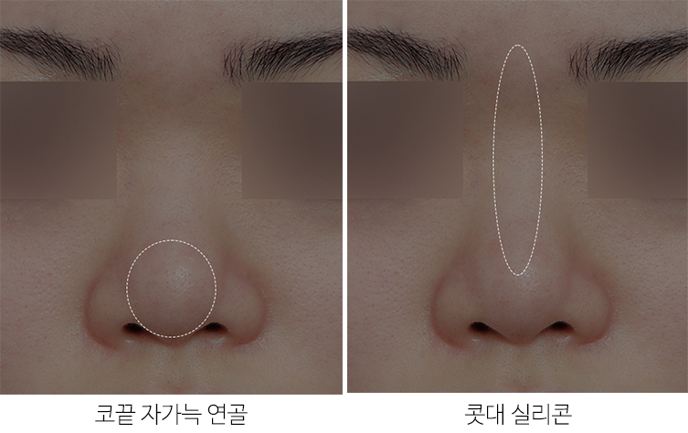 Upturned Nose Surgery_Naturally with Tip Lengthening image 3