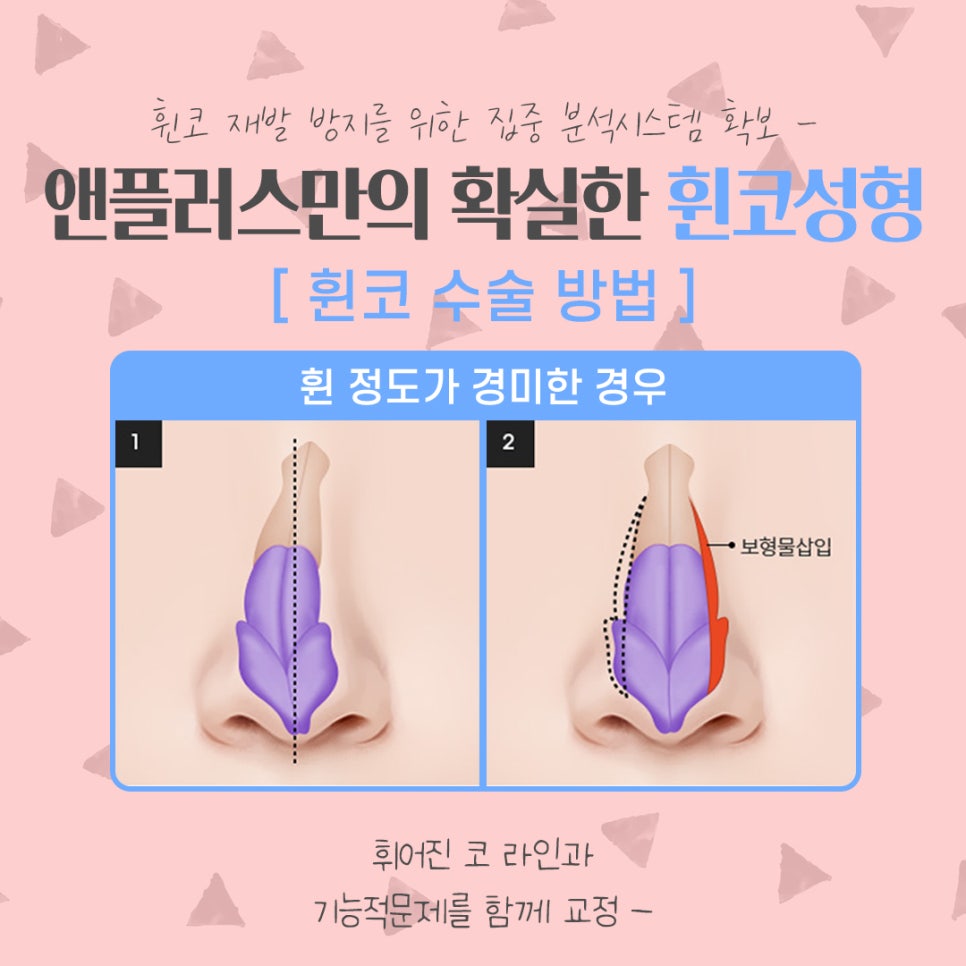 휜코수술후기 꼼꼼하게 알아보고 관련 이미지 8