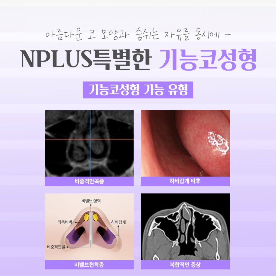 기능코성형후기에 대한 체크리스트 관련 이미지 5