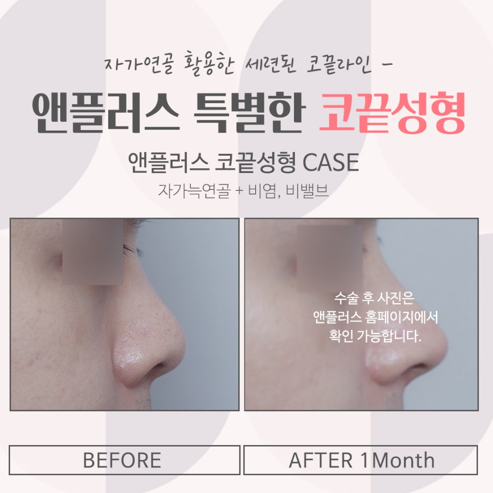 코끝성형후기로 세련된 코 라인 관련 이미지 16