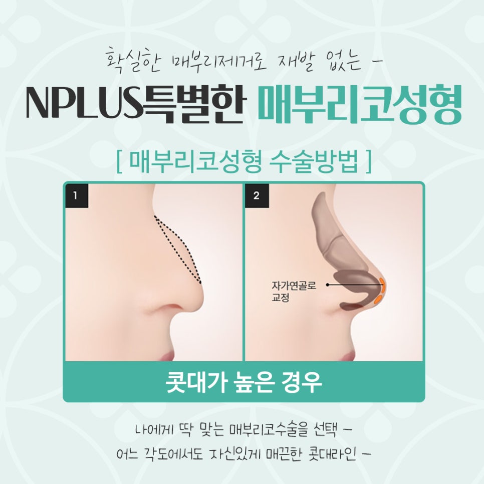 매부리코수술후기 자연스럽고 세련된 라인으로 관련 이미지 8