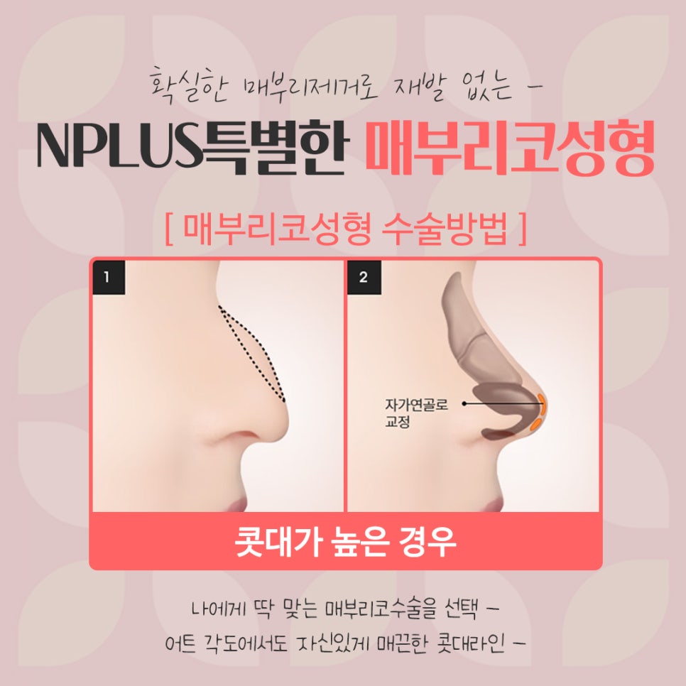 매부리코수술후기 자세하게 알아봐야 관련 이미지 9