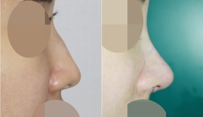 앤플러스 코재수술후기 전후사진 관련 이미지 1