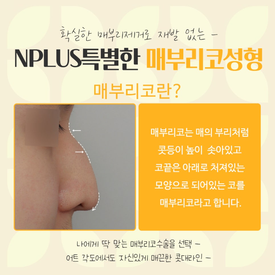 Detailed Review of Hump Nose Surgery, Including Function image 4