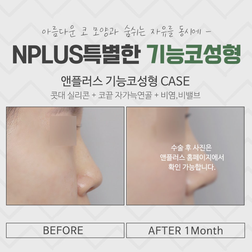 한쪽코막힘 개선으로 시원한 일상 관련 이미지 13