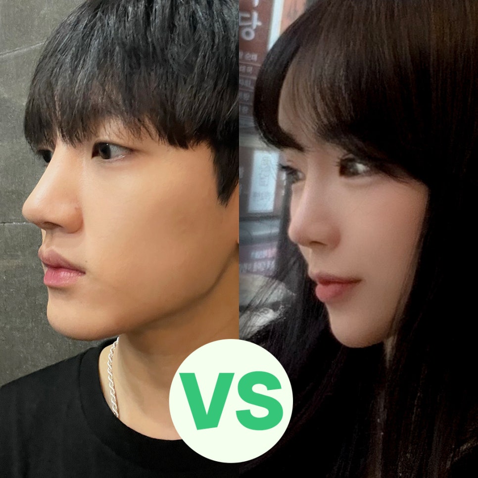 Learn About Before and After Male Nose Surgery in Various Ways image 10