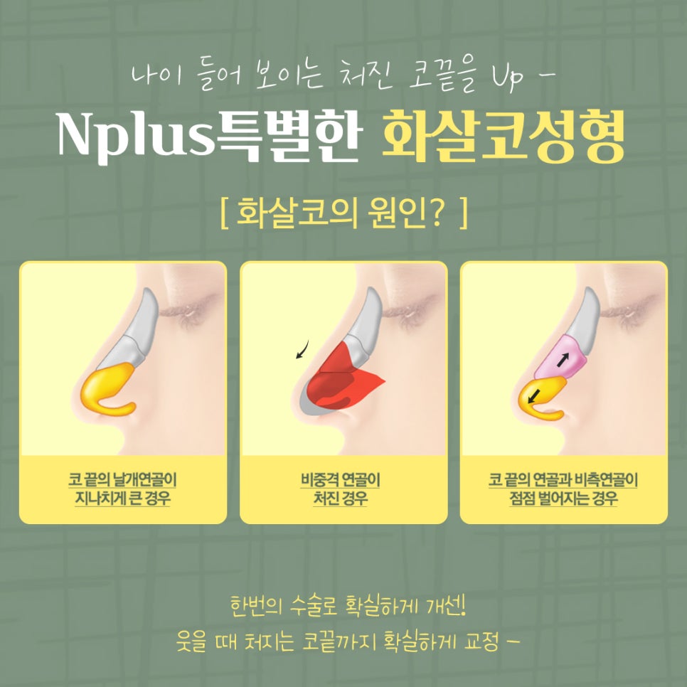 화살코성형 후기까지 확실하게 관련 이미지 6