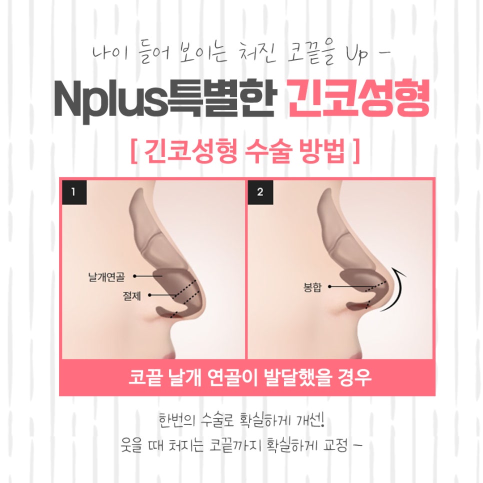 긴코성형 후기까지 알아보고 관련 이미지 9