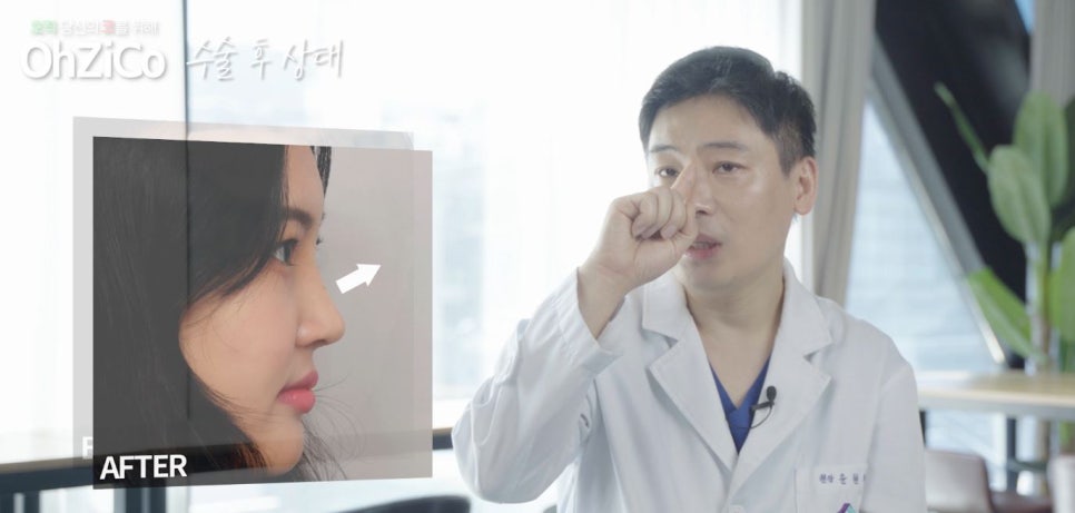 짧은코수술 후기까지 자세하게 알아보고 관련 이미지 5