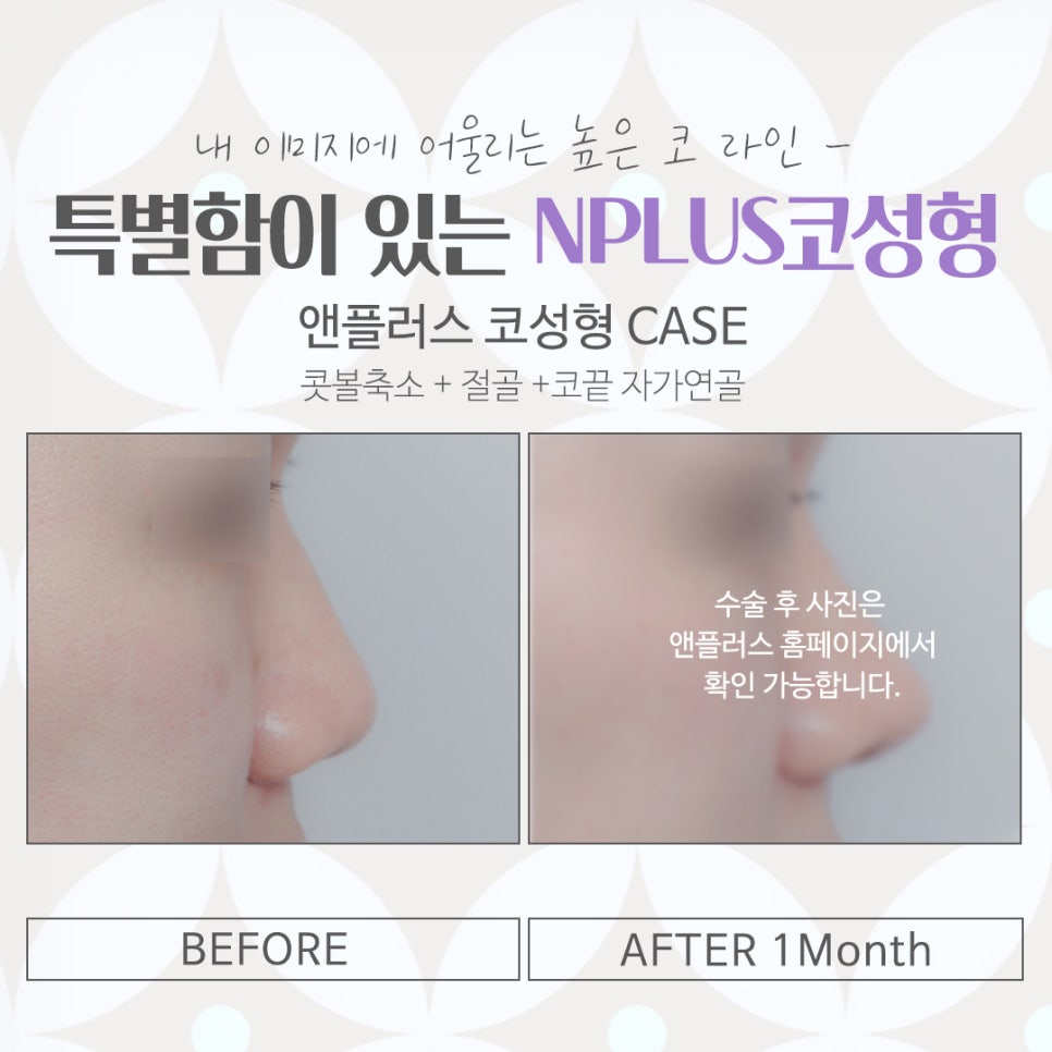 코수술잘하는곳 자세하게 알아보고 관련 이미지 14