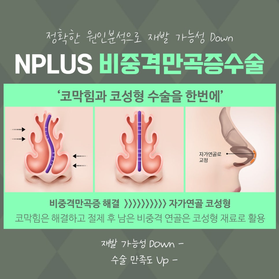 비중격코수술 원인 파악을 확실하게 관련 이미지 9