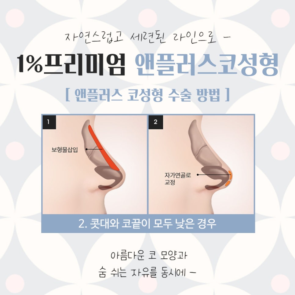 자가늑코성형에 대해 다양하게 알아보고 관련 이미지 9