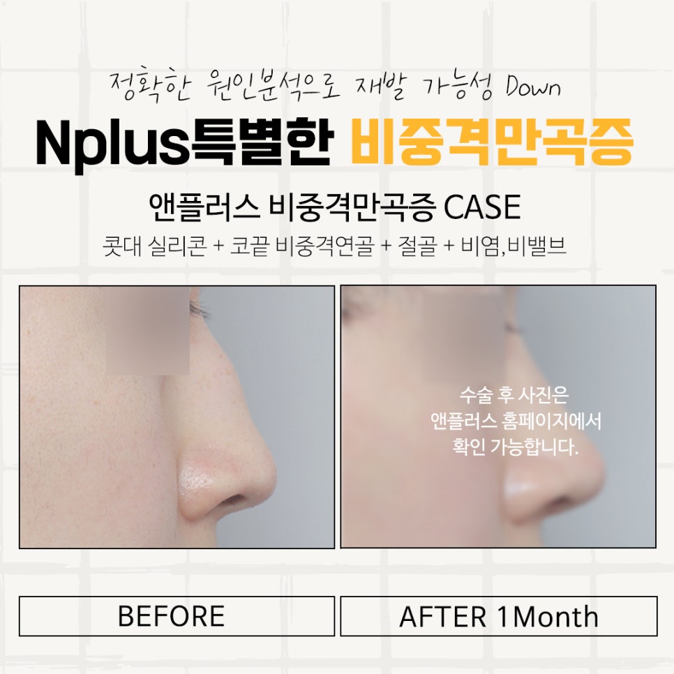Septoplasty Surgery Review: With a Careful Decision image 14