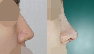 앤플러스 성형외과 : 매부리코성형 수술 전후 관련 이미지 1