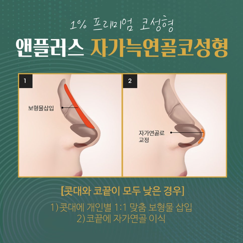 자가늑연골코수술로 처음부터 확실하게 관련 이미지 3