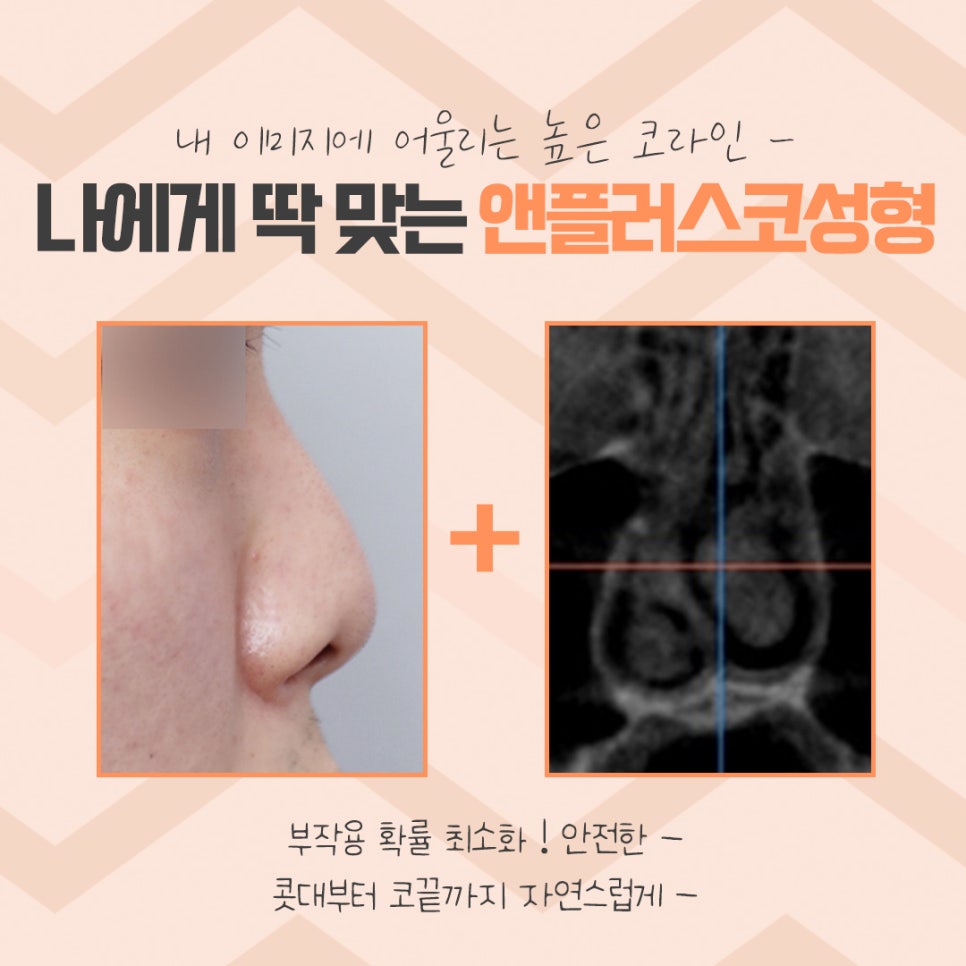 코성형 후기로 알아보고 결정 관련 이미지 5