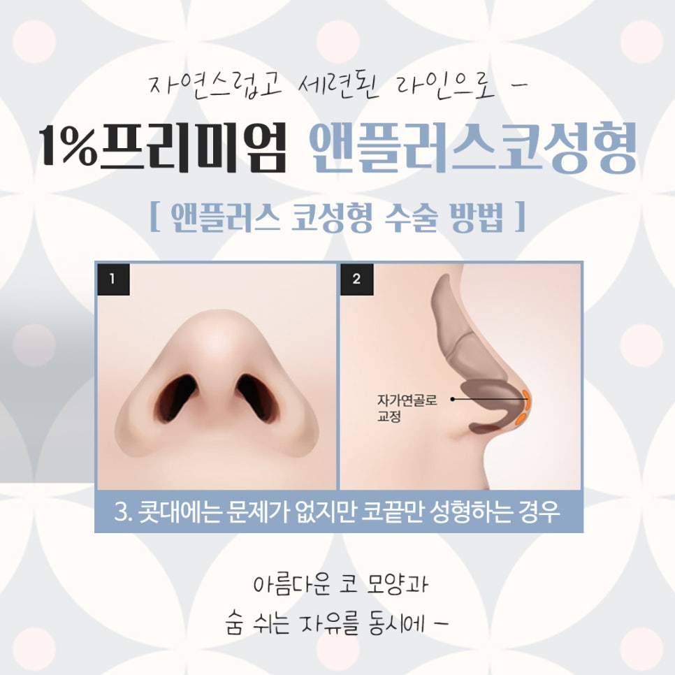 자가늑코성형에 대해 다양하게 알아보고 관련 이미지 10