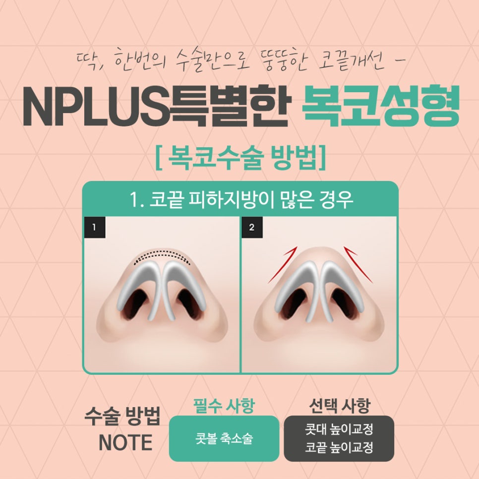 복코성형후기 코지방제거로 확실하게 관련 이미지 7