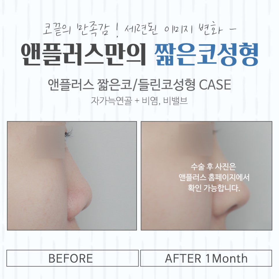 A Beautiful Nose Line with Short Nose Surgery image 15
