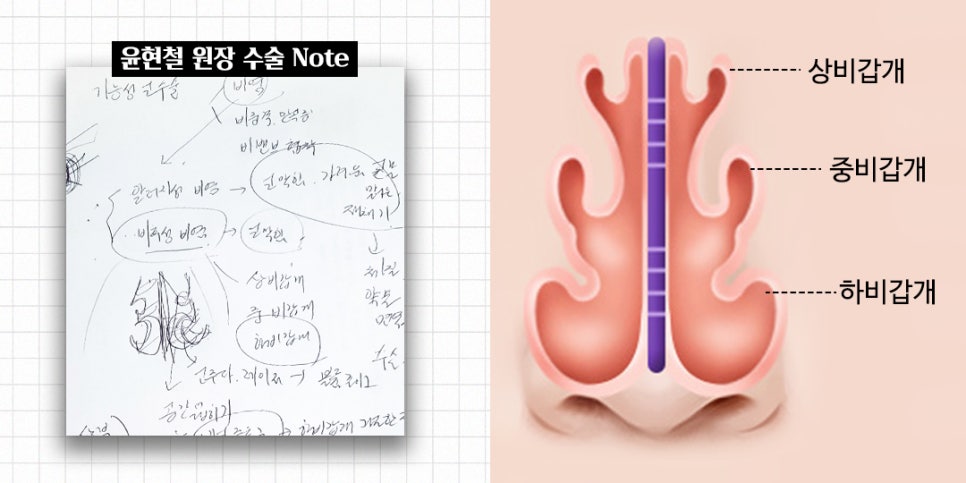 비염코성형에 대한 모든 것 완벽 정리 관련 이미지 2