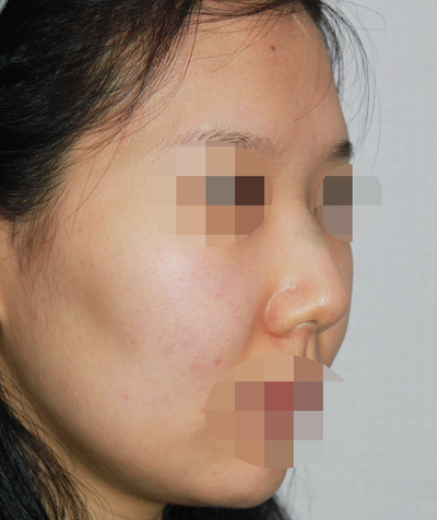1_여자 매부리코 수술전후 관련 이미지 2