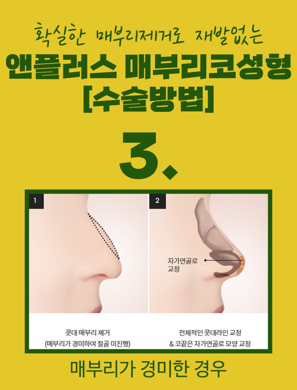 매부리코교정후기_깔끔하게 제거해야 관련 이미지 7