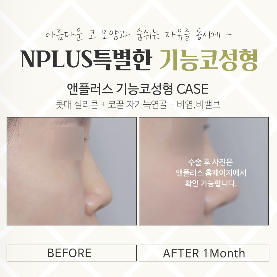 Detailed Information on Functional Rhinoplasty Reviews image 15