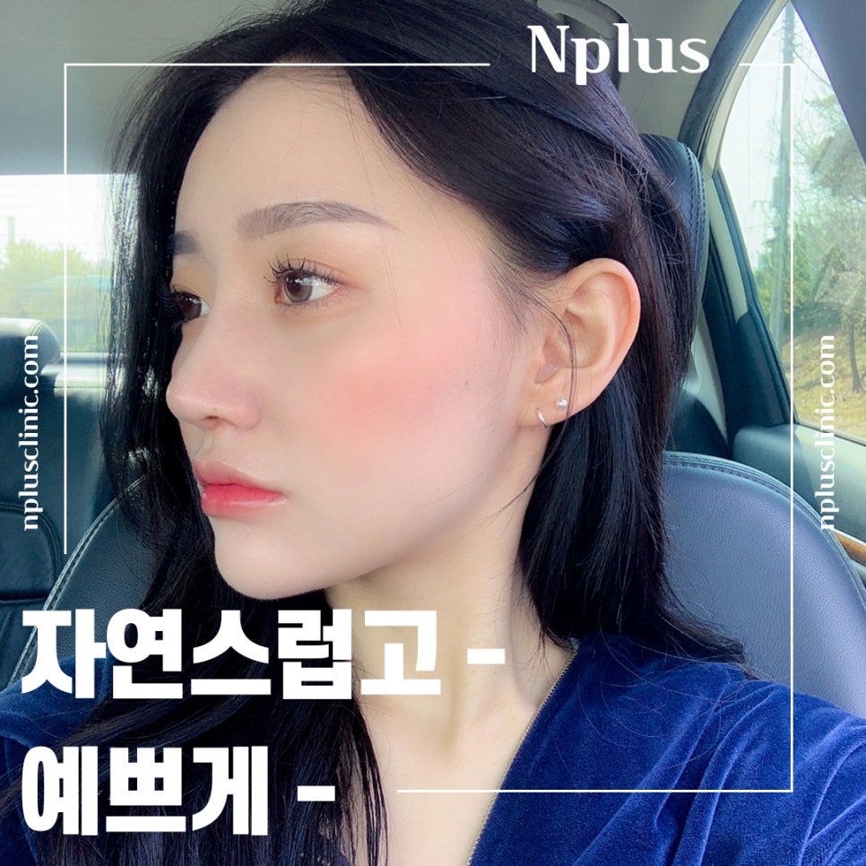 Significantly Improve an Upturned Nose with Surgery image 5
