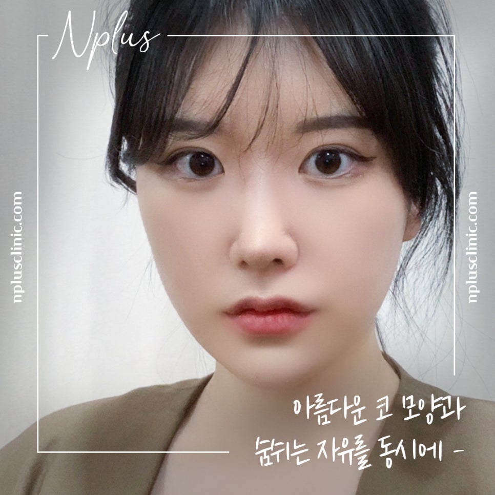 Nose Tip Surgery Review: Natural Results with Nose Tip Cartilage Stitching image 3