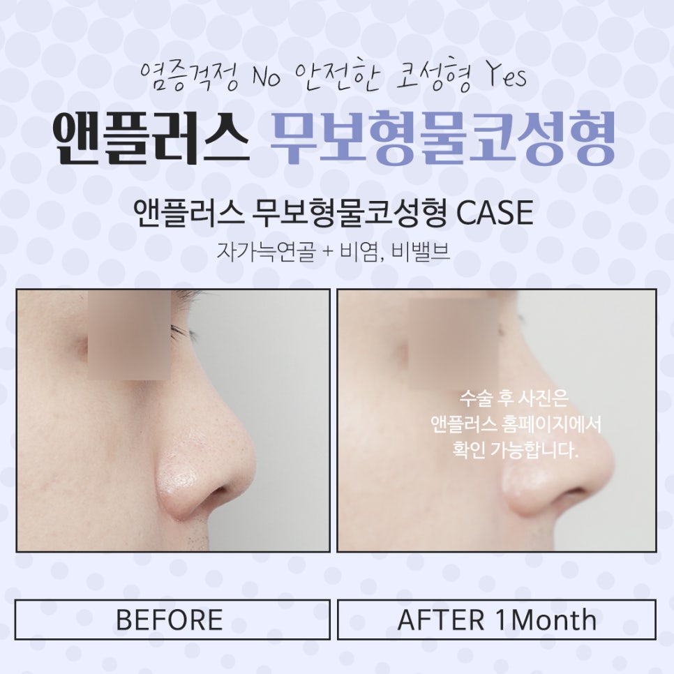 Review of Non-Implant Nose Surgery for a Beautiful Line image 14