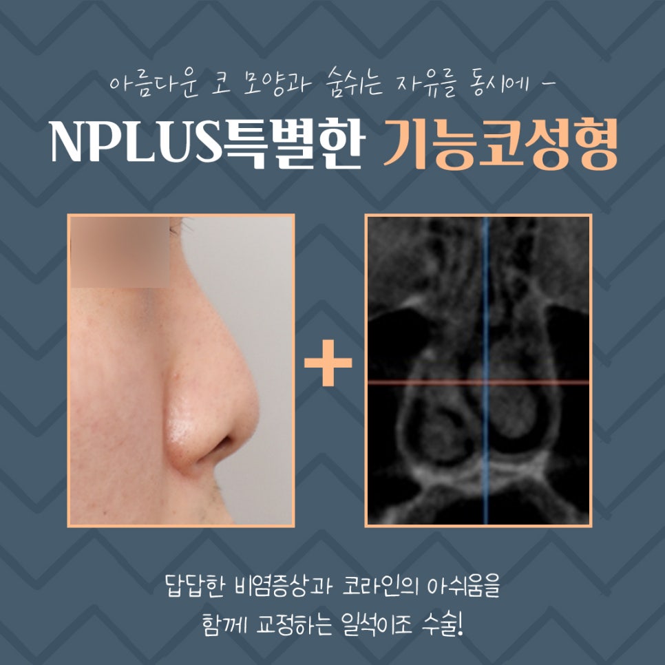 기능코성형후기 정확한 원인 분석으로 관련 이미지 4
