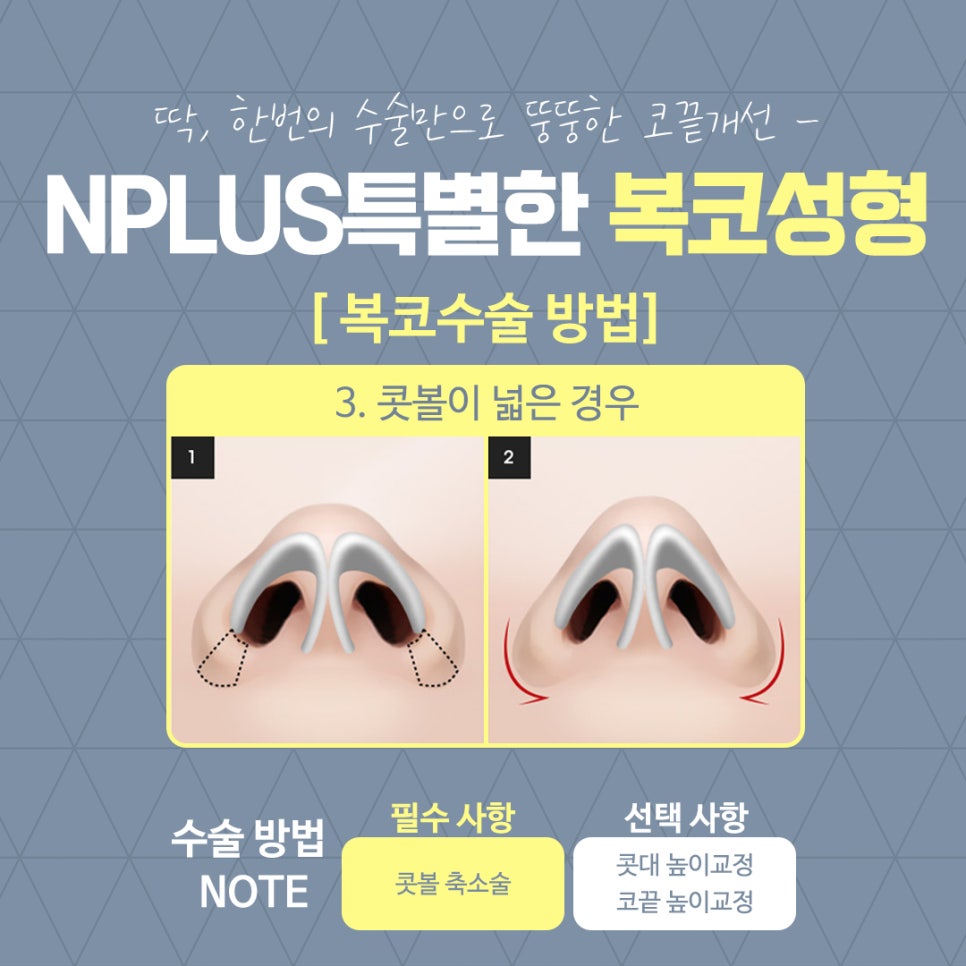 복코수술후기를 통해 예쁜 코라인으로 관련 이미지 11