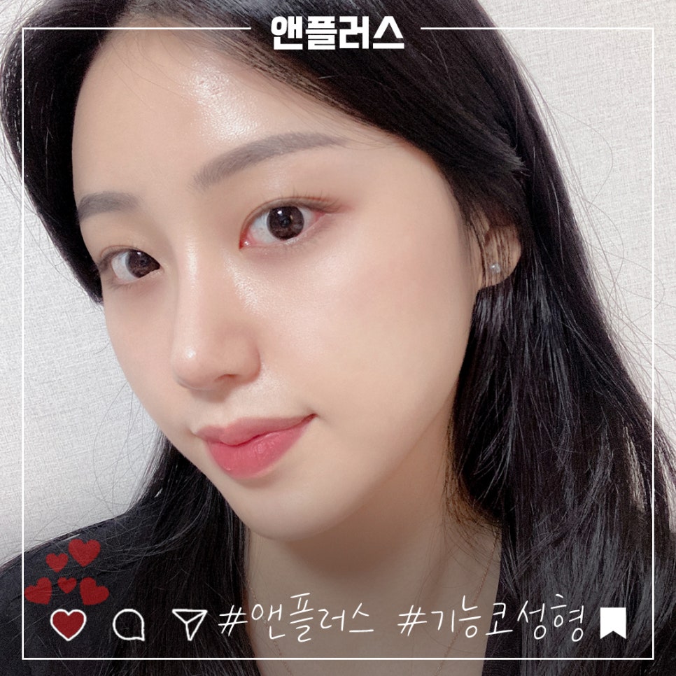 Before and After Female Nose Surgery in Various Ways image 6