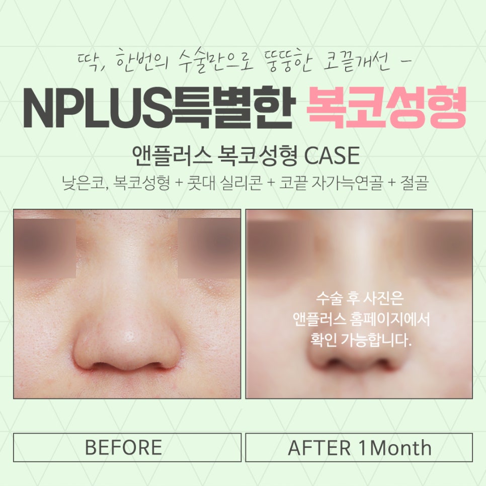 Before and After Bulbous Nose Surgery: Accurately Identifying the Cause image 14