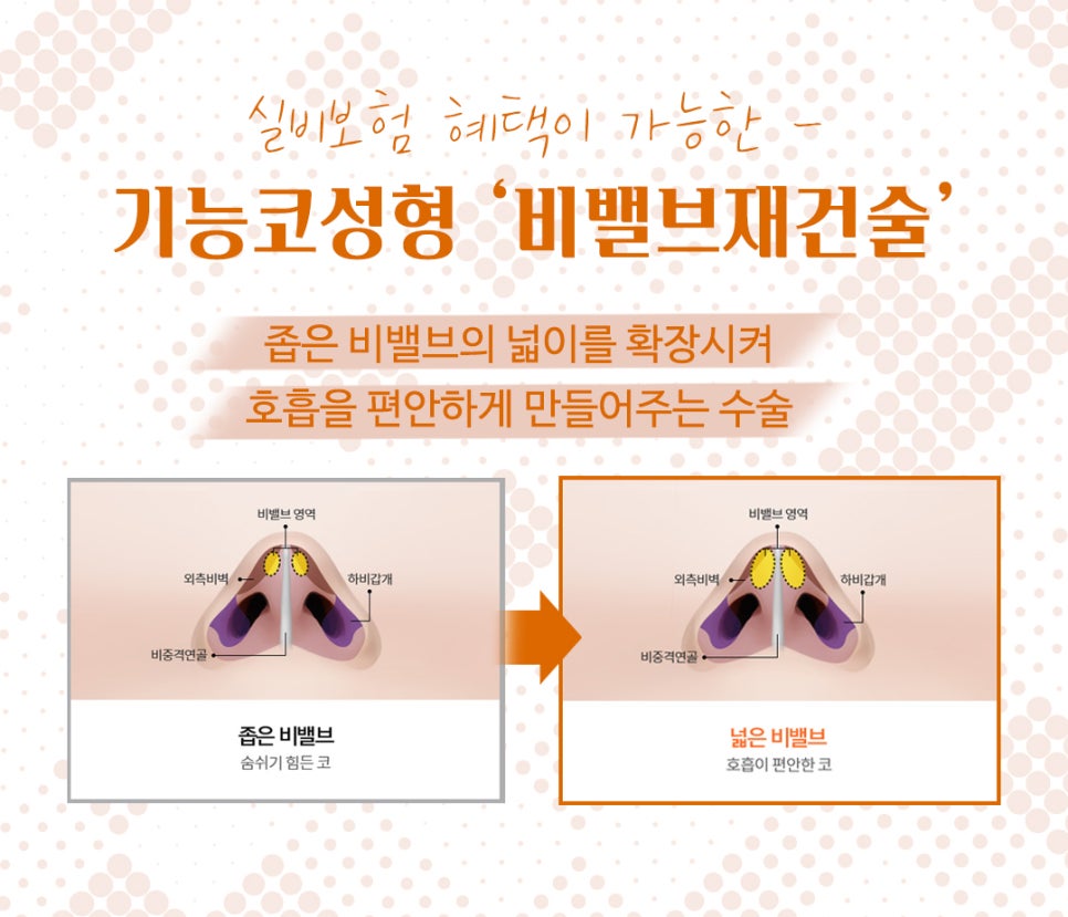 비밸브협착증 코수술방법 완벽 정리 관련 이미지 3