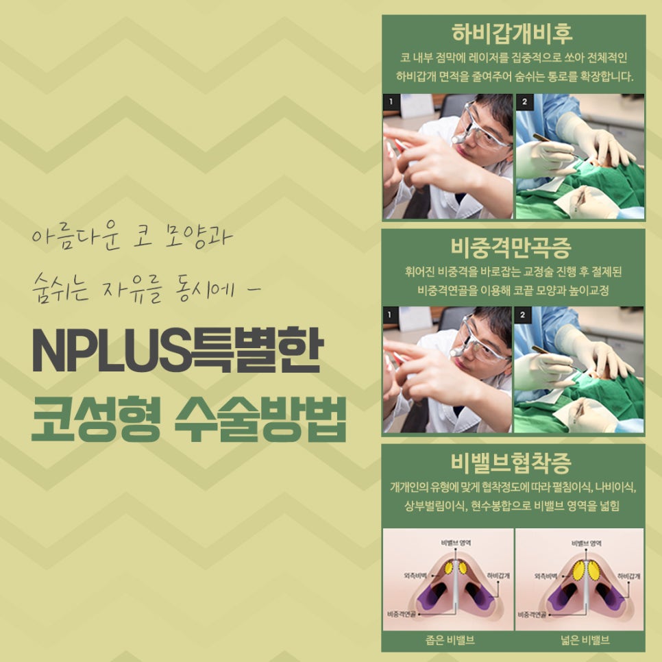 코성형전후 꼼꼼하게 비교하고 결정 관련 이미지 9