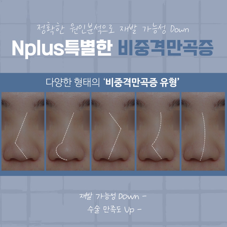 The Importance of Choosing a Septoplasty Review image 6
