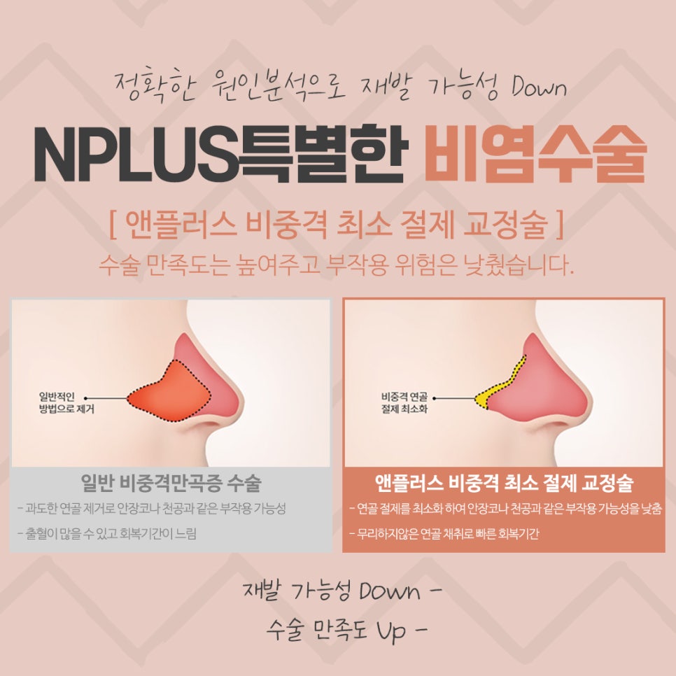 비중격수술후기 정확하게 파악해야 관련 이미지 11