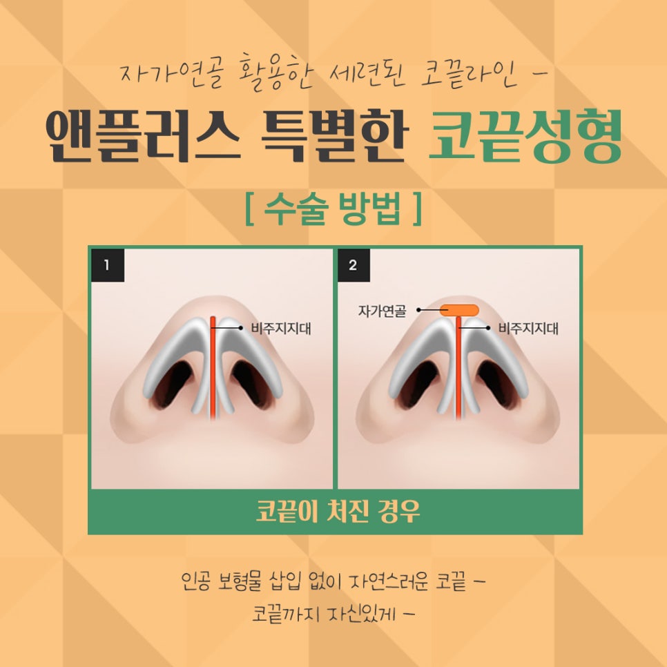 Nose Tip Surgery Review Found at Gangnam & Plus image 10