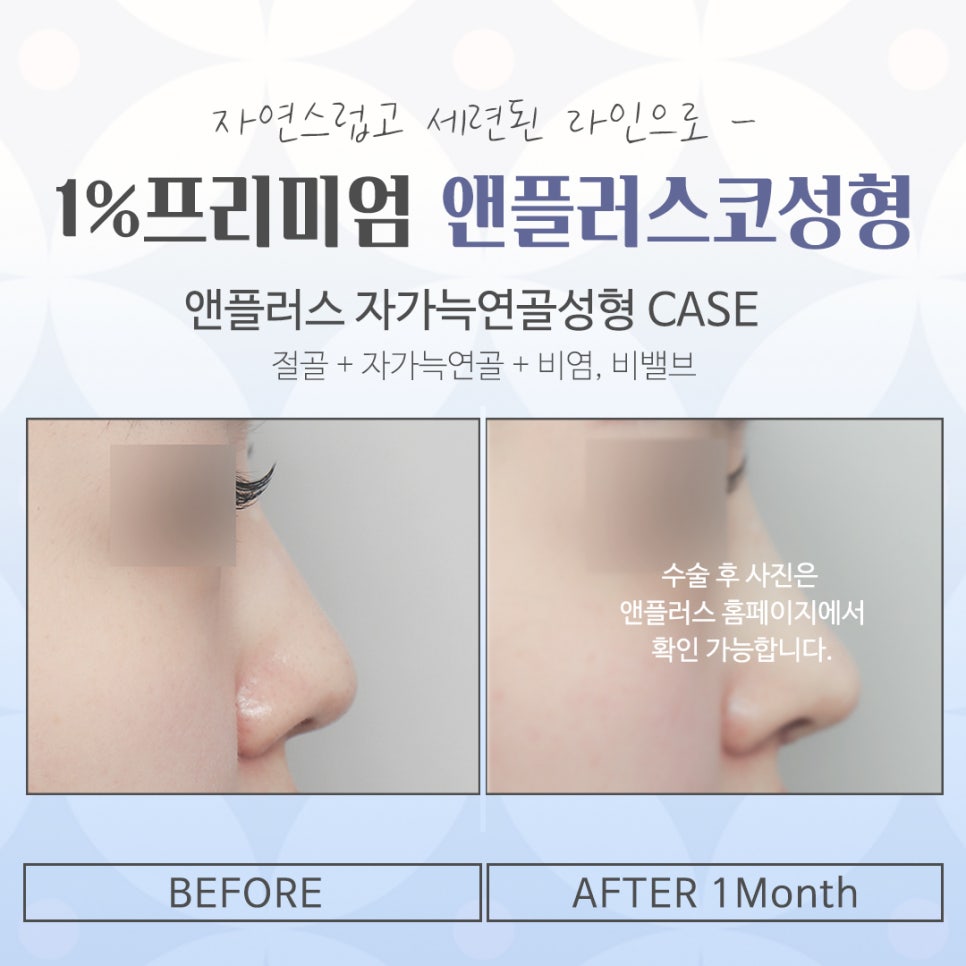 늑연골코성형을 고민한다면 관련 이미지 12