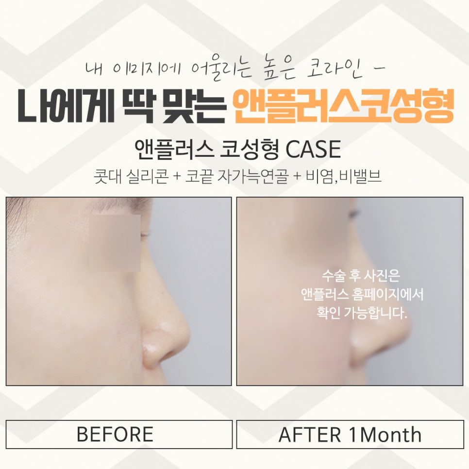코수술후기에 대해 자세하게 알아보고 관련 이미지 16