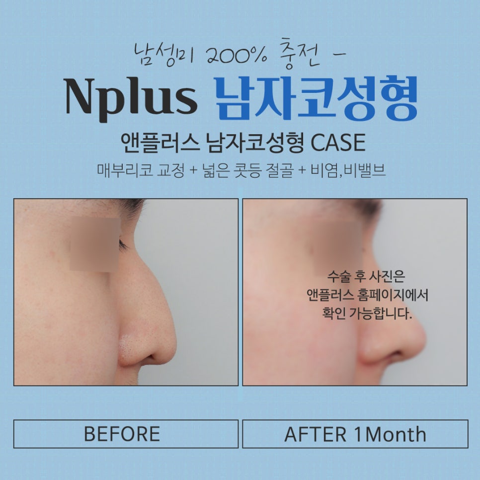 남자코성형 직선라인으로 남자답게 관련 이미지 12