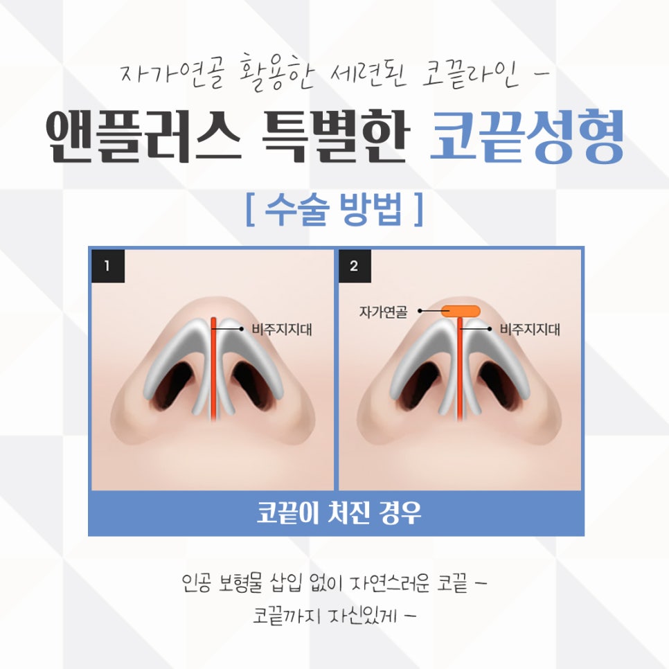 Nose Tip Surgery Review: Natural Results with Nose Tip Cartilage Stitching image 11