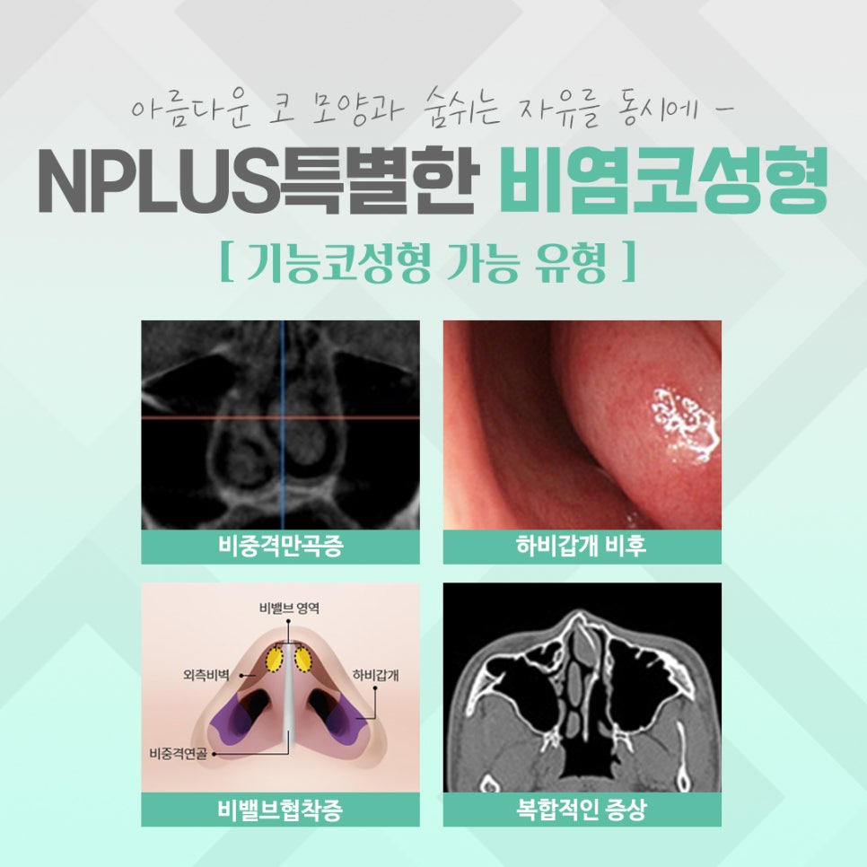 비염수술 내부 진단을 통해 관련 이미지 4