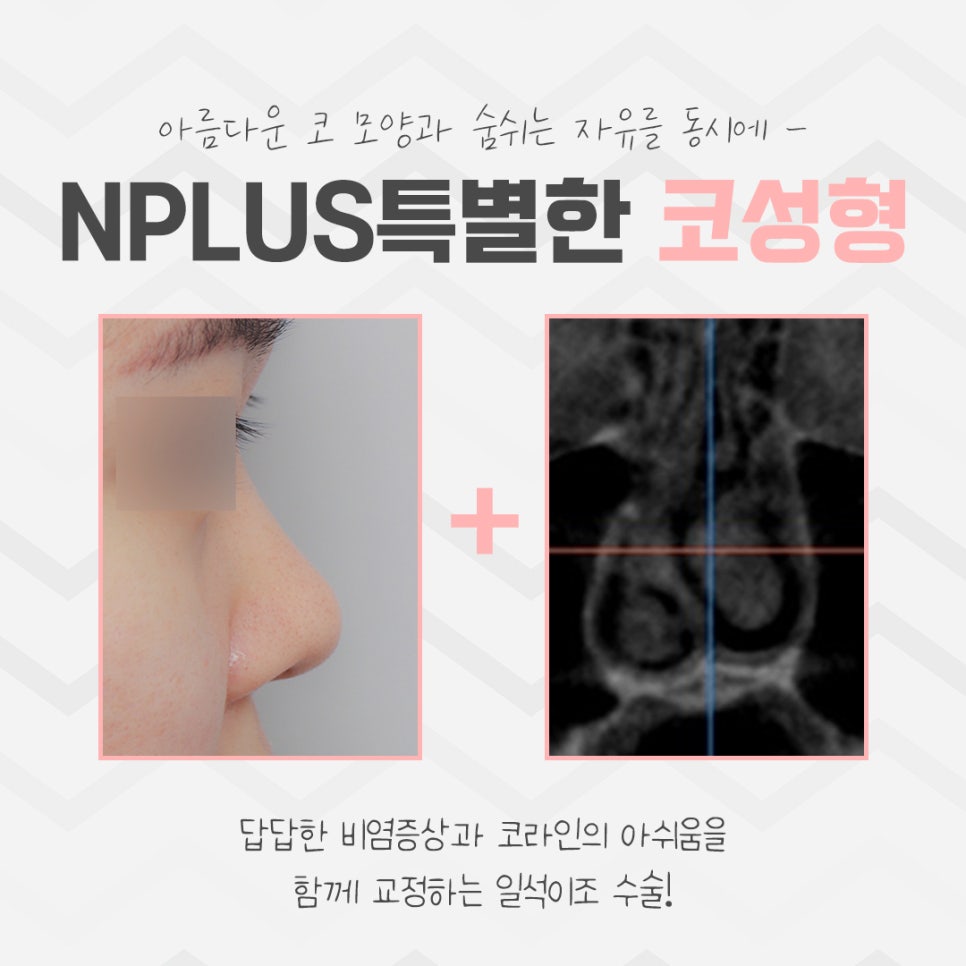 Building Confidence with a Refined Nose Line image 3